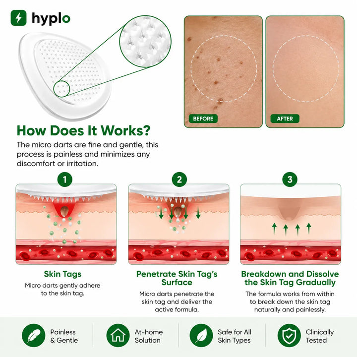 Gentle Skin Tag Patches – Soft Daily-Wear Patches for Smoother-Looking Skin